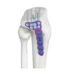 VAL Tấm khóa đĩa chày bên ngoài gần đầu trên