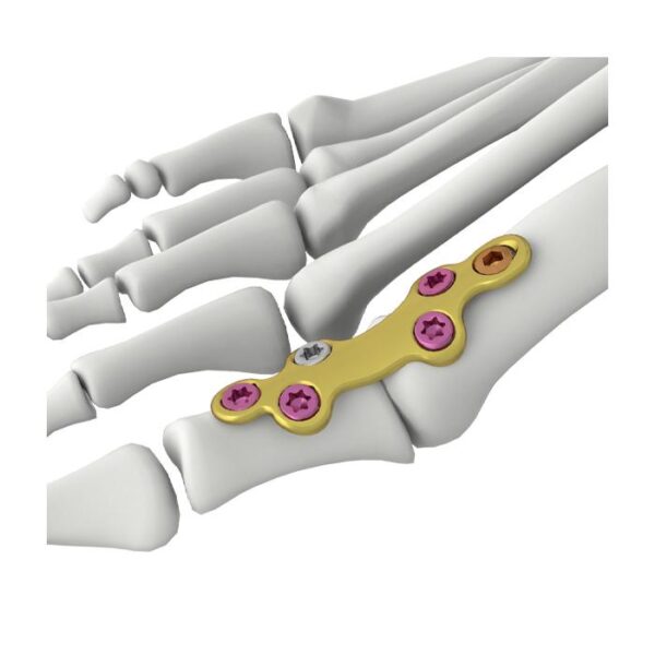 Itval MTP融合锁定接骨板