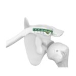 Tấm khóa móc xương đòn III